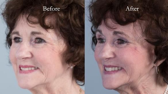 Newsletter 75: Marion’s case - Step-by-step complete denture workflow