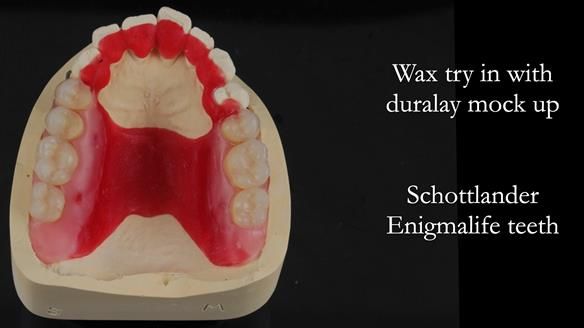 Newsletter 56 showing the making and fitting of a bilateral free end saddle upper removable partial denture (RPD) for patient with pemphigus