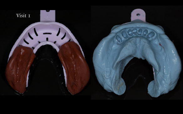 Figure 62 12 months post extraction of natural teeth - primary impression lower arch. Part 1 red cake (Kerr) compound to capture saddles and Part 2 impression making with alginate (Dentsply Blueprint)