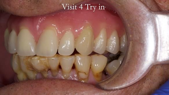 Newsletter 54 case presentation upper complete denture and lower Scandinavian designed hygienic partial denture for David