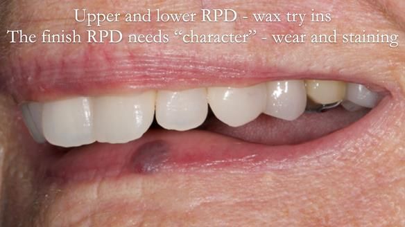 Eileen's transformation with upper and lower RPDs of Scandinavian hygienic design FULL PROTOCOL