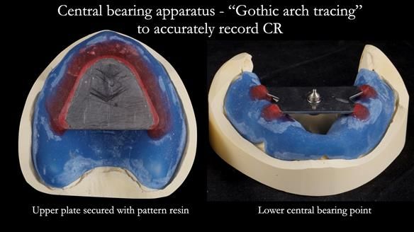 Newsletter 53 showing the making and fitting of ultra life-like dentures for Valena