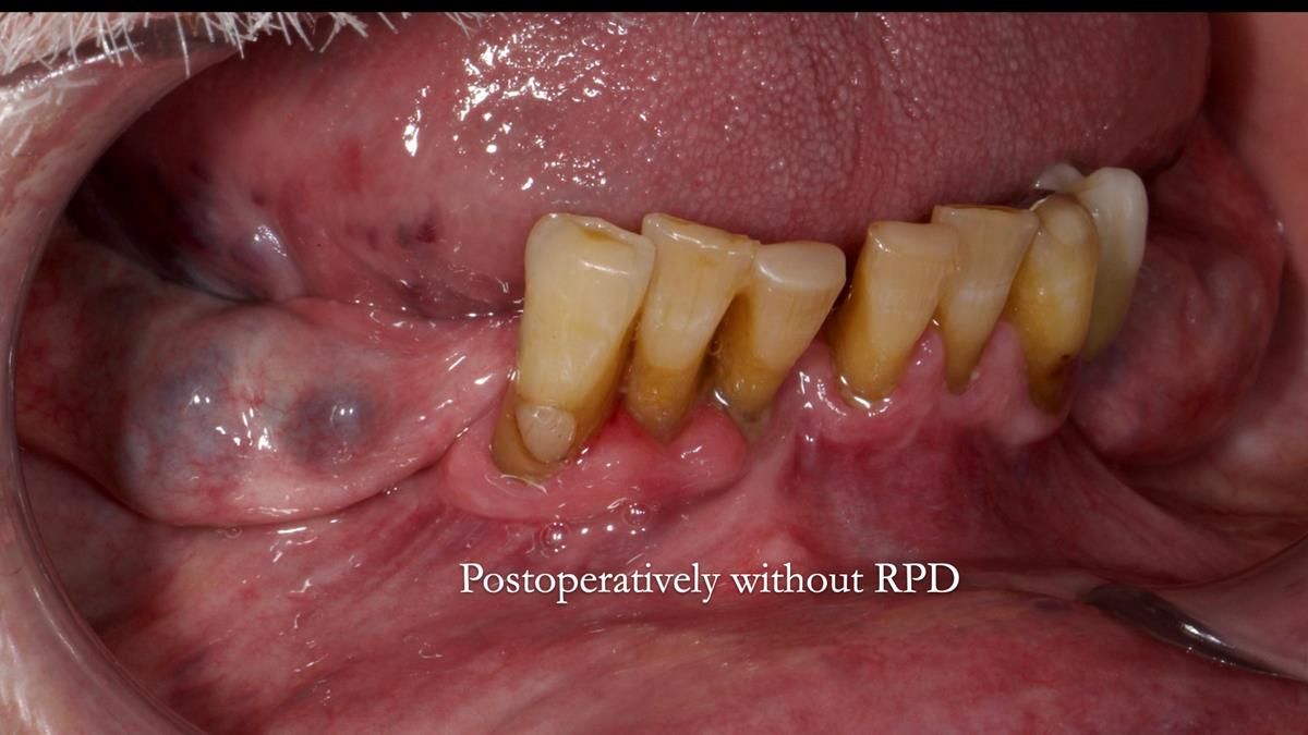 Newsletter 87 – Father Peter: A Partial Denture that needed Minor Miracle