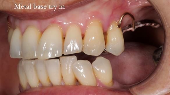 Newsletter 56 showing the making and fitting of a bilateral free end saddle upper removable partial denture (RPD) for patient with pemphigus
