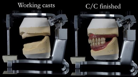 Newsletter 53 showing the making and fitting of ultra life-like dentures for Valena
