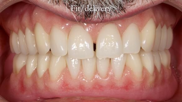 Newsletter 78: What do Clark Gable and a Locator® overdenture have in common?