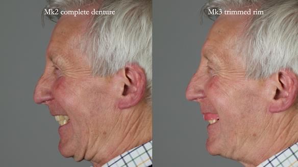Newsletter 77: Jeremy’s case – immediate complete upper denture