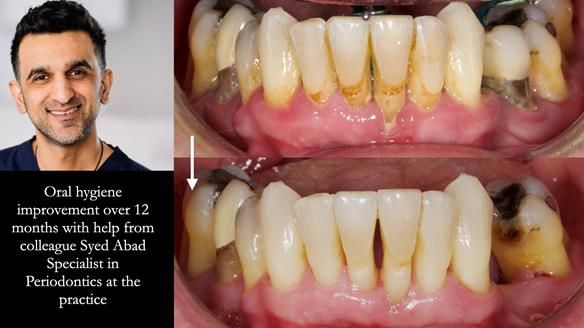 Newsletter 77: Jeremy’s case – immediate complete upper denture