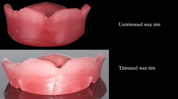Newsletter 82 Mary - A complete upper and a one-tooth gasket denture