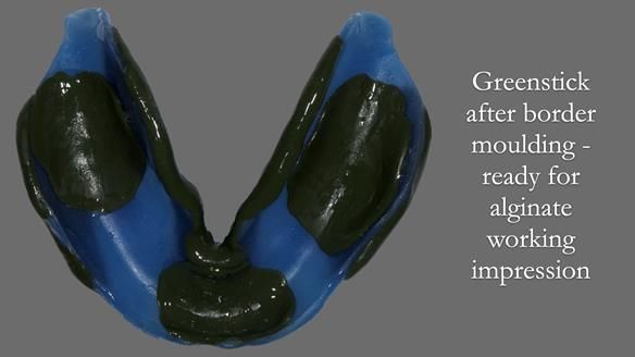 Newsletter 53 showing the making and fitting of ultra life-like dentures for Valena