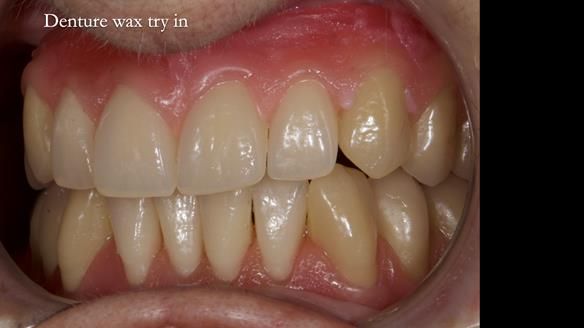 Newsletter 83: Sheila’s Complete Denture Success