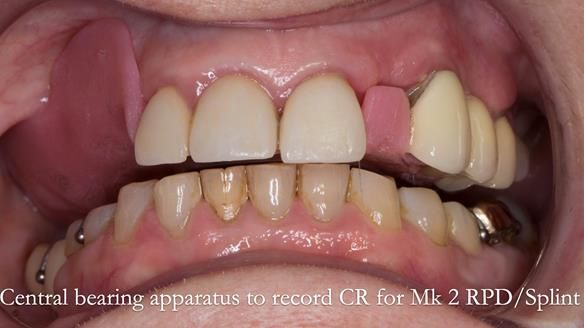 Newsletter 51 Managing Anne’s failing dentition with distal extension base RPD/Splint FULL PROTOCOL