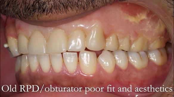 Acrylic based partial denture/obturator had poor, retention and support Obturator section was in poor condition. The Adams clasp were causing inflammation of the gingival margins. The clasp on the UR3 was visible resulting in poor appearance. Reduced lip