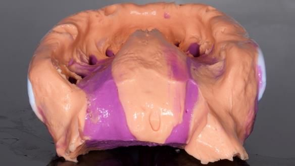 Finlay's Newsletter 64 case study - provision of a Kennedy class 2 metal based Scandinavian RPD for Ian