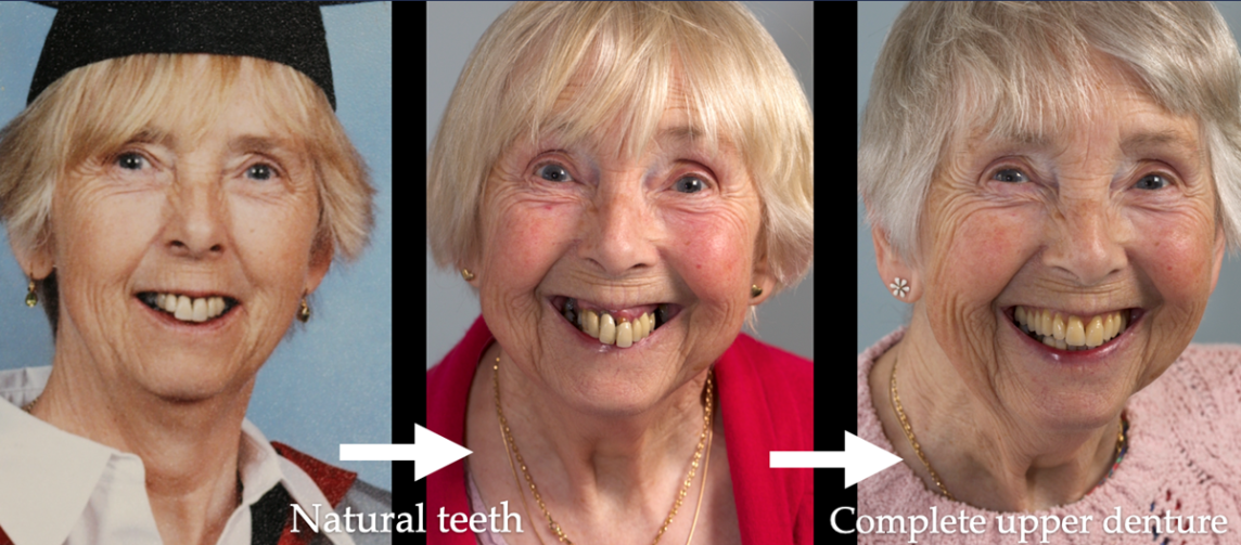 Extremely natural looking immediate complete upper denture - full protocol immediate through to definitive dentures