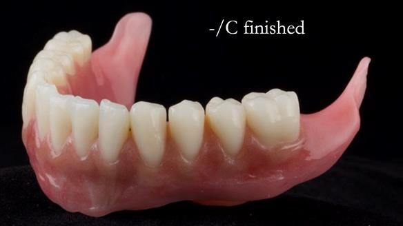 Managing poor implant positioning with complete dentures and Locator attachments - full protocol Newsletter 41