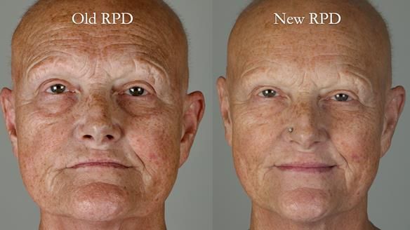 Newsletter 81 - Pam’s Story — how a partial denture changed her life (+ live walkthrough this Thursday)