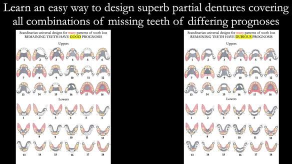 Finlay's Newsletter 59 Ultra hard partial dentures made for Gill