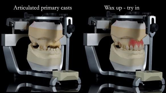 Newsletter 81 - Pam’s Story — how a partial denture changed her life (+ live walkthrough this Thursday)