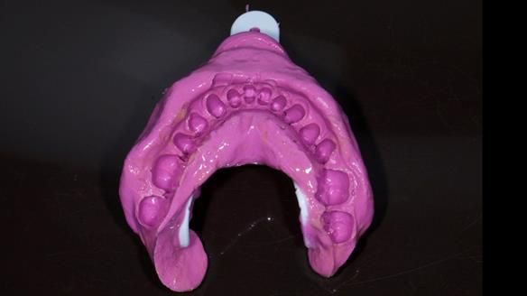 Finlay's Newsletter 64 case study - provision of a Kennedy class 2 metal based Scandinavian RPD for Ian