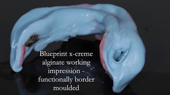 Finlay's Newsletter 59 Ultra hard partial dentures made for Gill