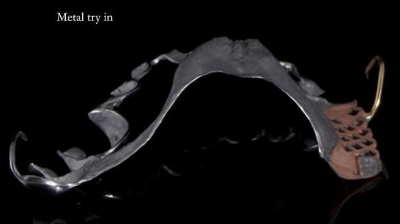 Finlay's Newsletter 64 case study - provision of a Kennedy class 2 metal based Scandinavian RPD for Ian