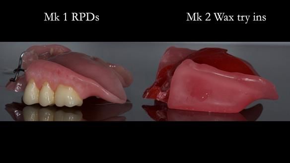 Finlay's Case Study Newsletter 40 - Immediate Mk 1 RPD to Definitive Mk 2 RPD - full protocol