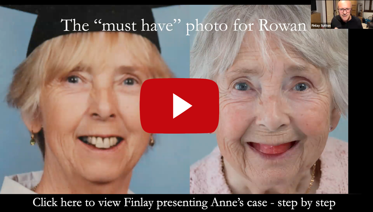 This is my lecture/webinar explaining in detail this case for my full membership presentation to the British Academy of Aesthetic Dentistry in October 2020 - https://youtu.be/LoxEQAaqf5c
