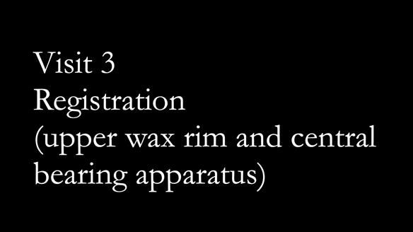 Solving Linda’s Failed “All on 4” implant bridges - full protocol Newsletter 42