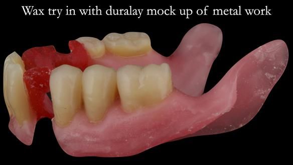 Finlay's Case Study Newsletter 40 - Immediate Mk 1 RPD to Definitive Mk 2 RPD - full protocol