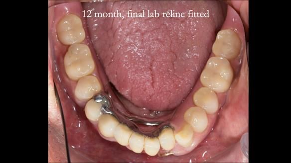 Ken – going downhill, first class