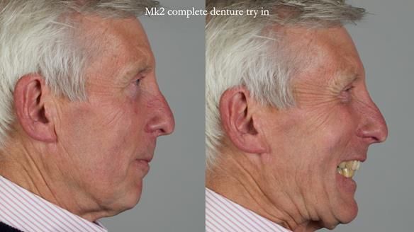 Newsletter 77: Jeremy’s case – immediate complete upper denture