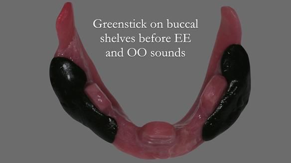 Finlay's Newsletter 62 provision of extractions and metal based complete dentures for Rafique