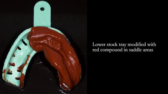 Newsletter 82 Mary - A complete upper and a one-tooth gasket denture