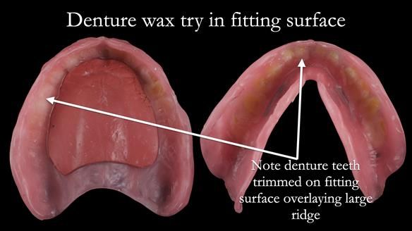 Newsletter 53 showing the making and fitting of ultra life-like dentures for Valena