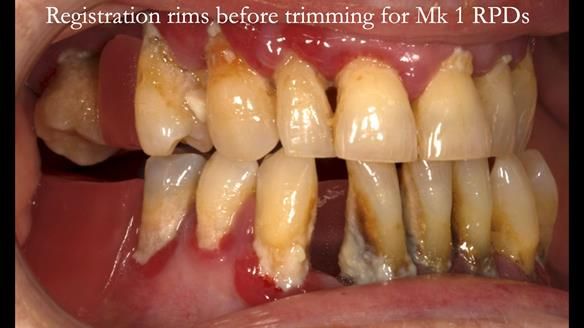 Finlay's Case Study Newsletter 40 - Immediate Mk 1 RPD to Definitive Mk 2 RPD - full protocol