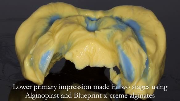 Newsletter 57 showcases the making and fitting process of implant-supported complete dentures for Alisdair