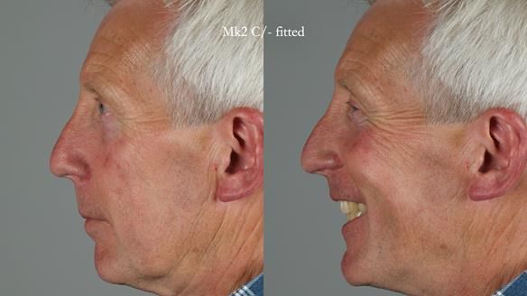 Newsletter 77: Jeremy’s case – immediate complete upper denture