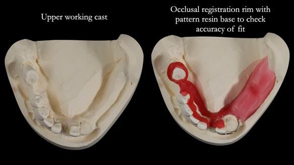 Newsletter 55 Provision of metal based partial dentures for Zephyrine with a repaired cleft lip and palate