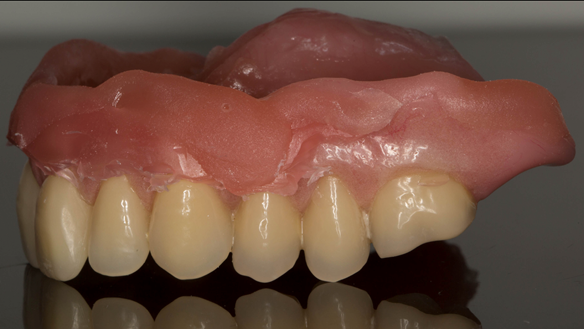 Figure 46 The wax has been removed and the reline can now be trimmed.