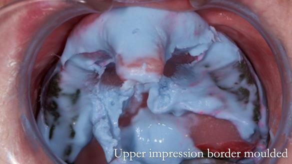 Replacing Madeline’s Complete denture FULL PROTOCOL