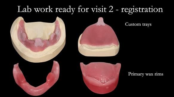 Managing poor implant positioning with complete dentures and Locator attachments - full protocol Newsletter 41