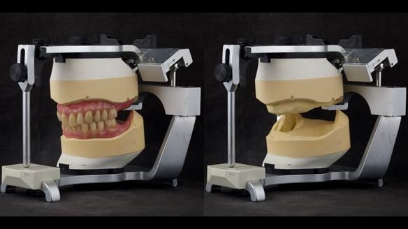 Complete denture Class II div 2 deep overbite Newsletter 39