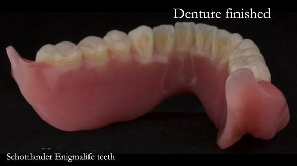 Newsletter 75: Marion’s case - Step-by-step complete denture workflow