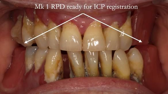 Finlay's Case Study Newsletter 40 - Immediate Mk 1 RPD to Definitive Mk 2 RPD - full protocol