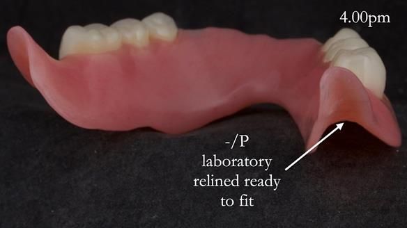 Newsletter 52 Managing Jo’s failing dentition with extractions and Mk 1/Mk 2 complete upper dentures and lower partial dentures FULL PROTOCOL