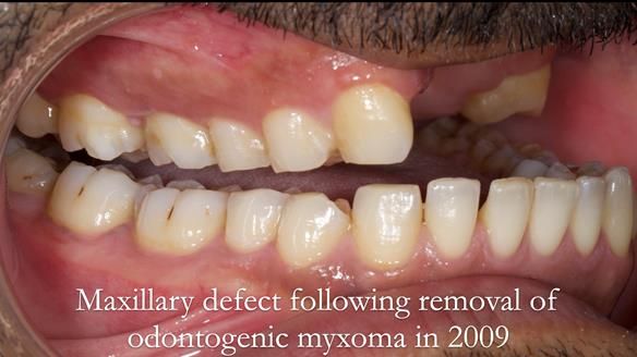 Upper metal base partial denture/occlusal stabilisation splint/obturator - full protocol