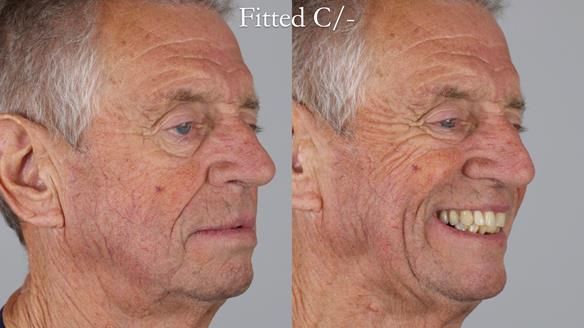 Newsletter 54 case presentation upper complete denture and lower Scandinavian designed hygienic partial denture for David