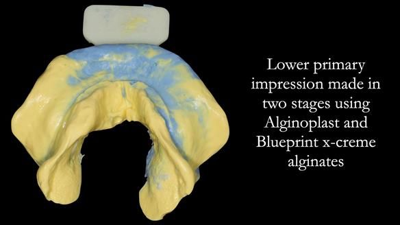 Newsletter 50 Special edition Complete Dentures FULL PROTOCOL