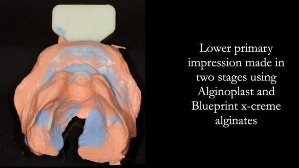 Newsletter 80 - Gordon’s dentures: the one case in 1,000 where my technique failed